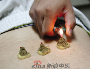 灸法的種類  你知道多少？